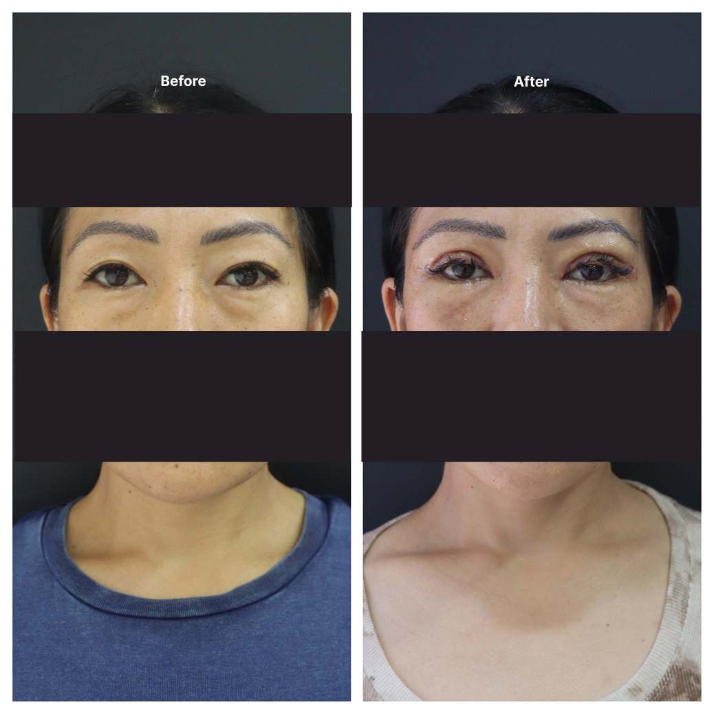 Eyelid Surgery KOQ10